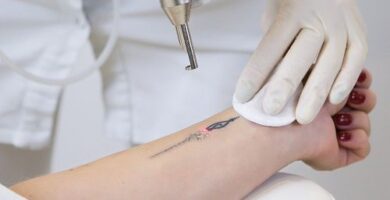 eliminar tatuajes barcelona